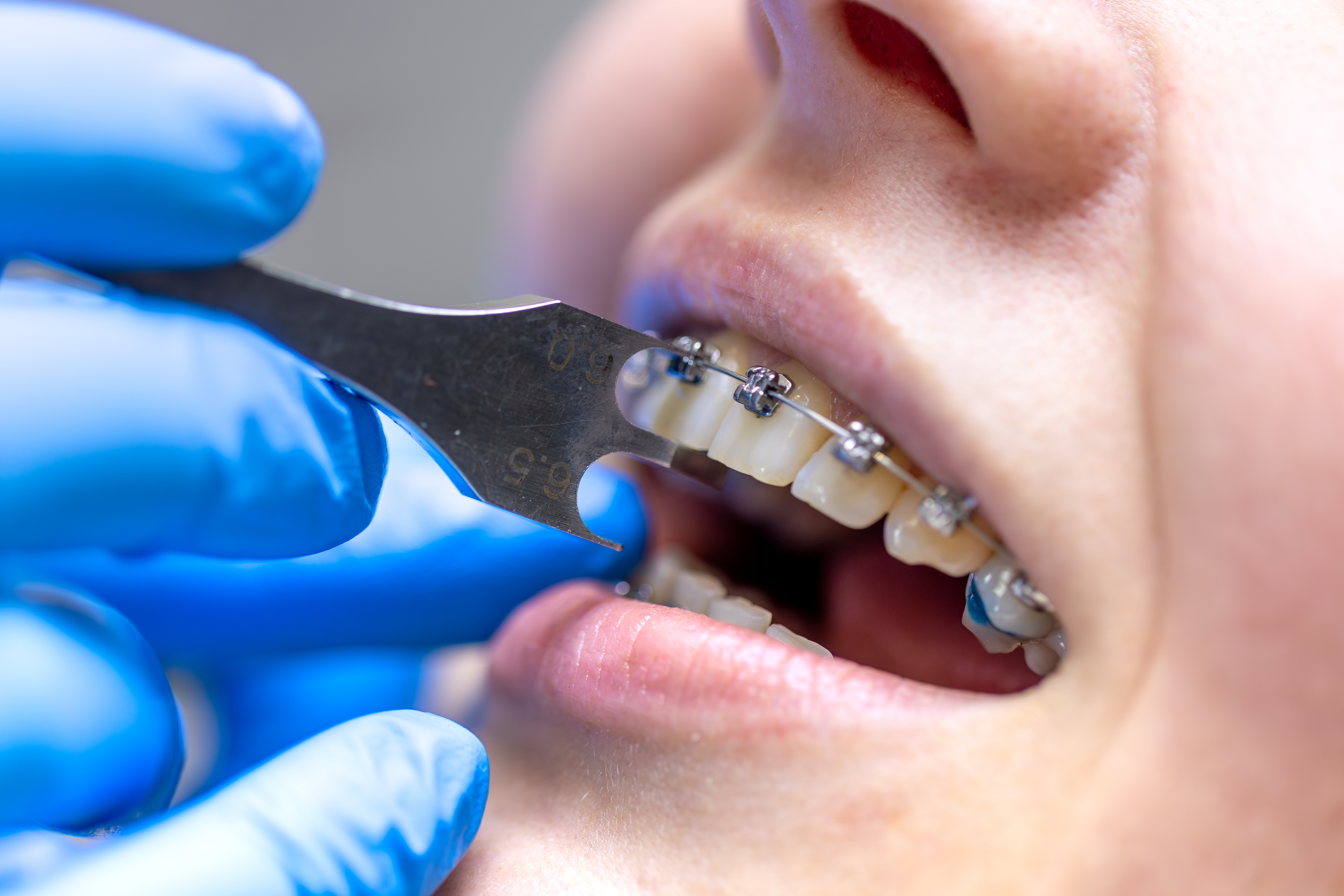 Orthodontic treatment